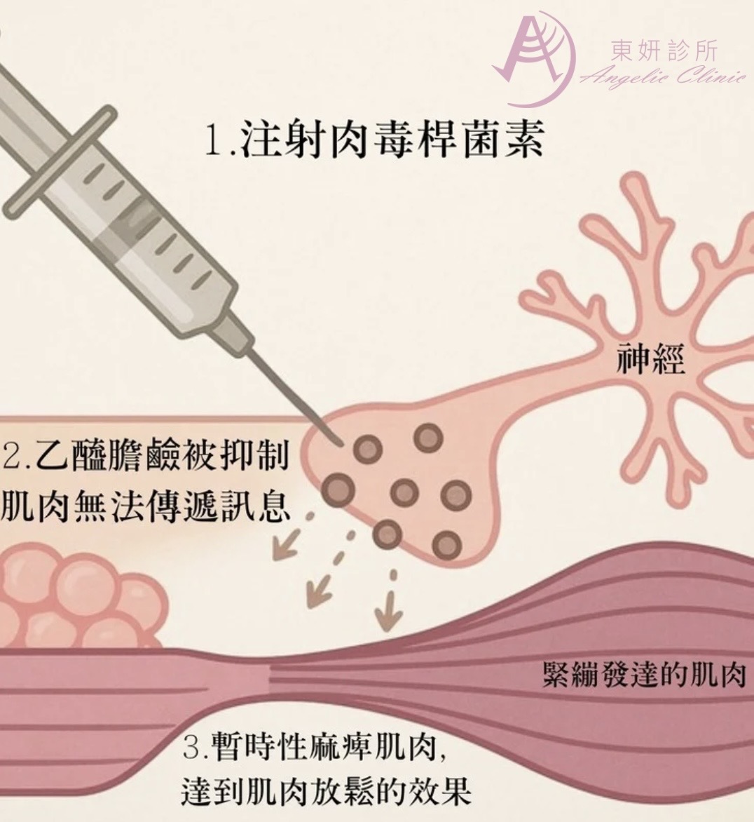 肉毒桿菌原理